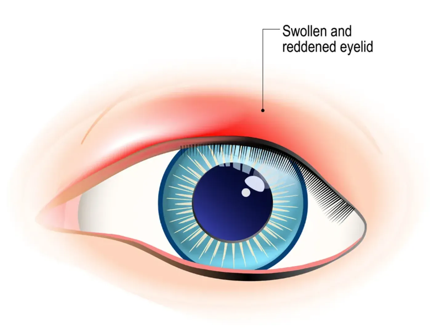Illustration of an eye with blepharitis, with the swollen and reddened upper eyelid margin labeled.