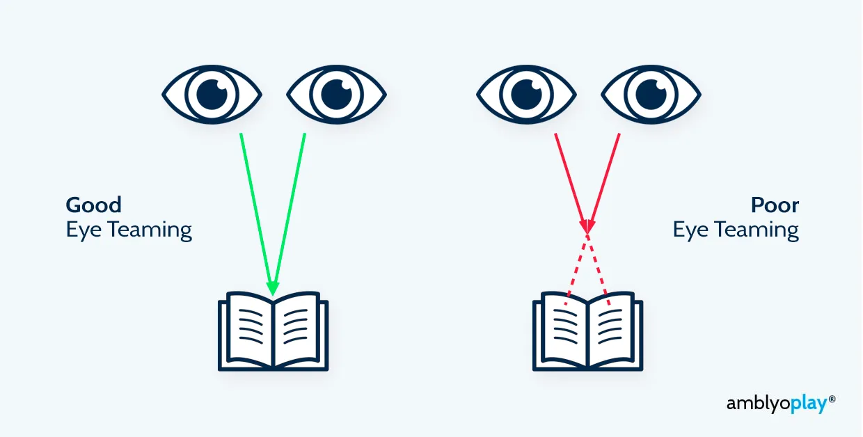 Diagram comparing good and poor eye teaming: with good teaming both eyes aim at the same point on an open book; with poor teaming the two lines of sight cross in front of the page instead of meeting on it.