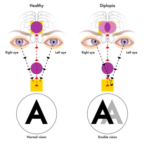 Two-panel diagram comparing healthy vision and diplopia. In the healthy panel the right eye and the left eye each send their image along the visual pathway to the brain, where the two are fused into a single letter A — normal vision. In the diplopia panel the two eyes' images are not fused, so the letter A is seen twice, one image overlapping the other — double vision.