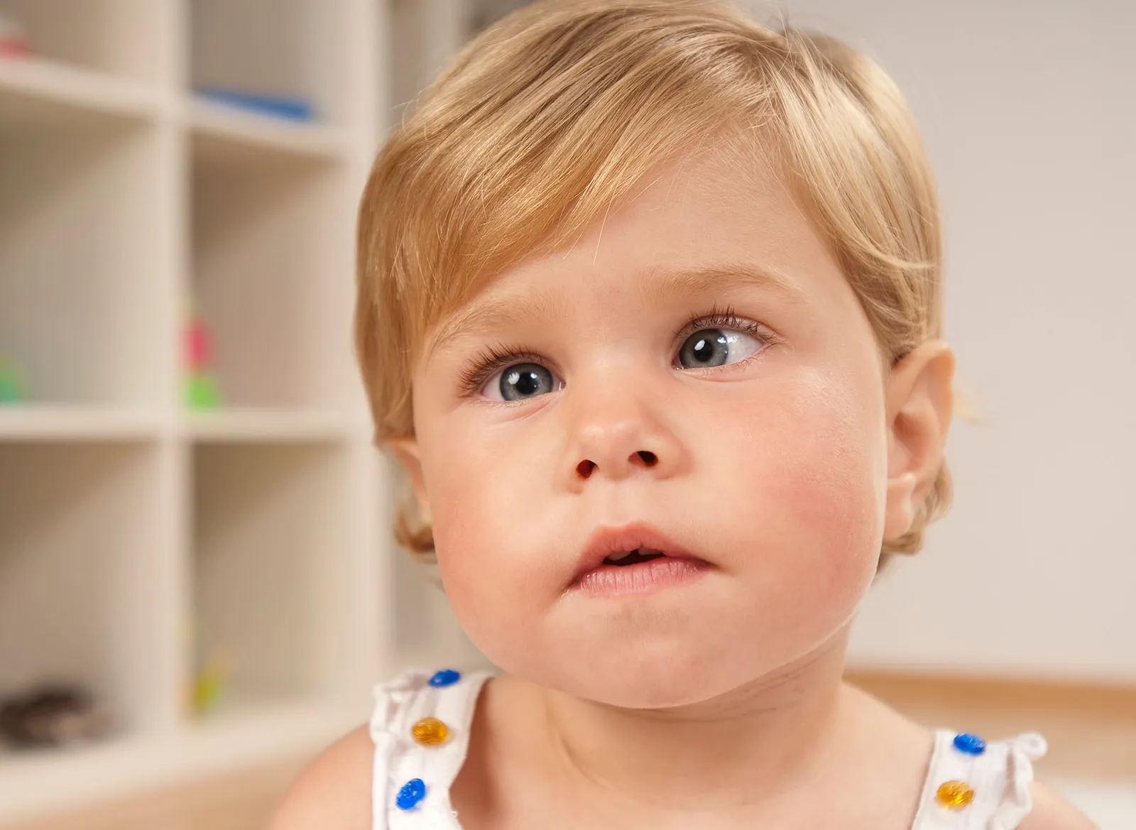 Close-up of a toddler whose eyes are not aligned — one eye drifts while the other fixates