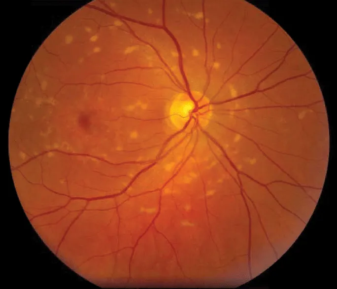 Retinal photograph showing pale yellow flecks scattered across the retina around the optic nerve, a pattern seen in Stargardt disease.