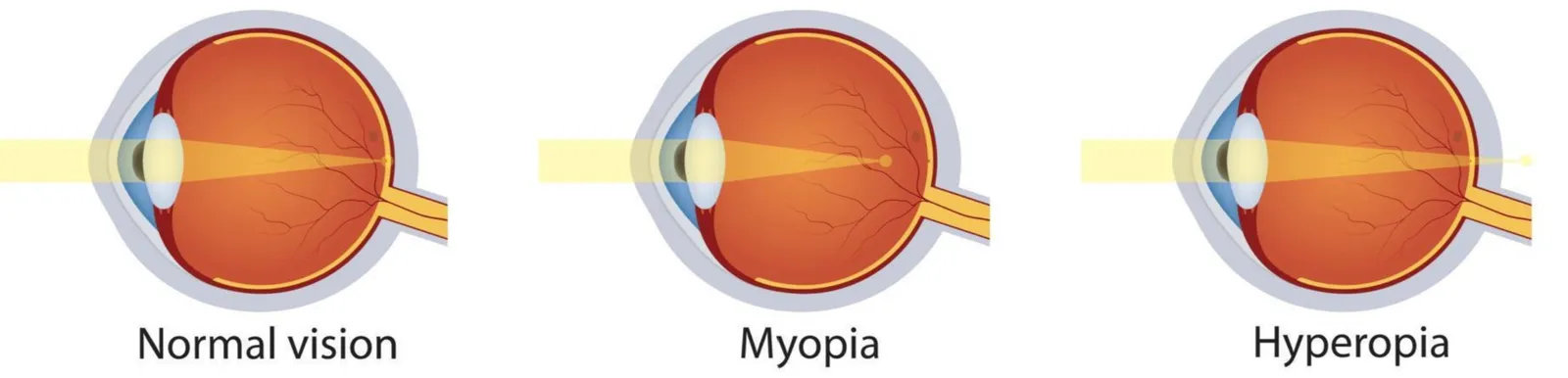 Three cross-sections of the eye labelled Normal vision, Myopia and Hyperopia, showing light coming to a focus on the retina, in front of the retina, and behind the retina