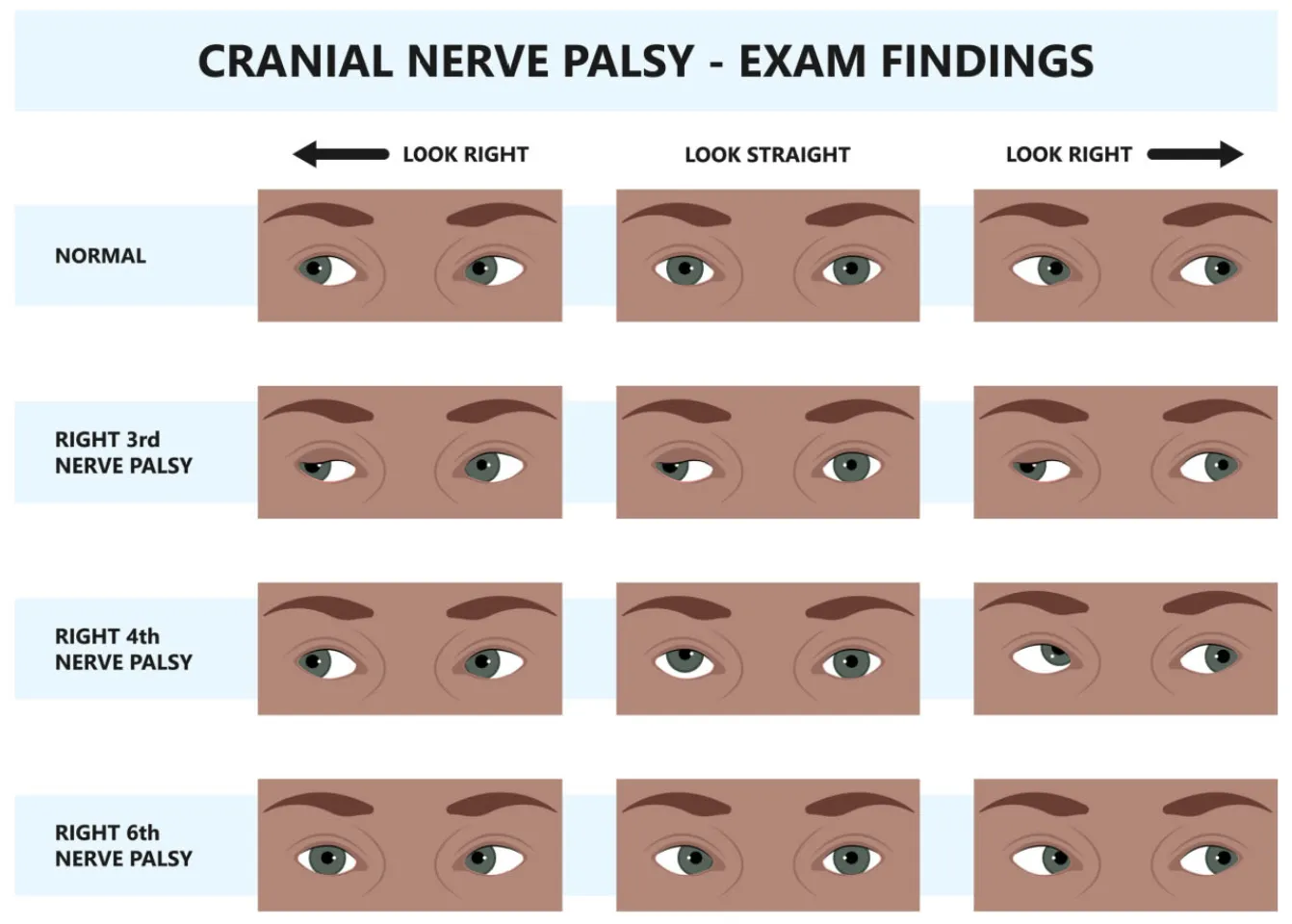 Chart of cranial nerve palsy exam findings, comparing normal eye movements with right third, fourth and sixth nerve palsies on left gaze, straight-ahead gaze and right gaze.