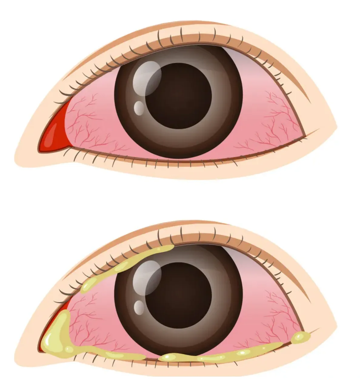 Illustration of two eyes with conjunctivitis: a pink, inflamed conjunctiva with visible blood vessels, and the same eye below with yellow discharge along the lid margins.