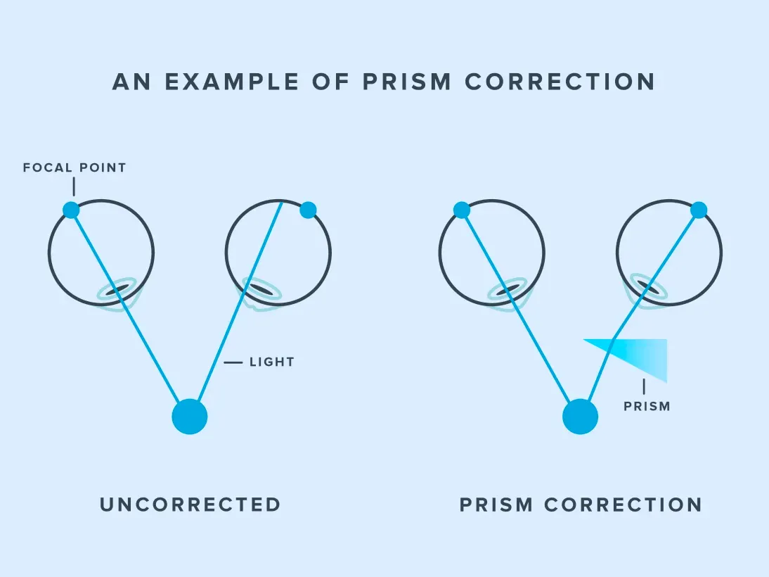 An example of prism correction: uncorrected, light from a single object reaches a different focal point in each eye; with a prism in front of one eye the light is bent so both eyes' images land in matching positions.