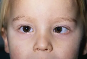 Close-up of a child's eyes in which one eye is turned inward toward the nose