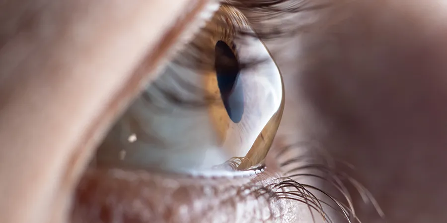 Close-up profile view of an eye whose cornea bulges forward into a cone shape