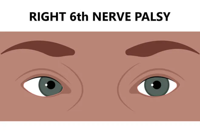 Illustration of a right sixth nerve palsy: the right eye stays turned inward and cannot rotate outward.