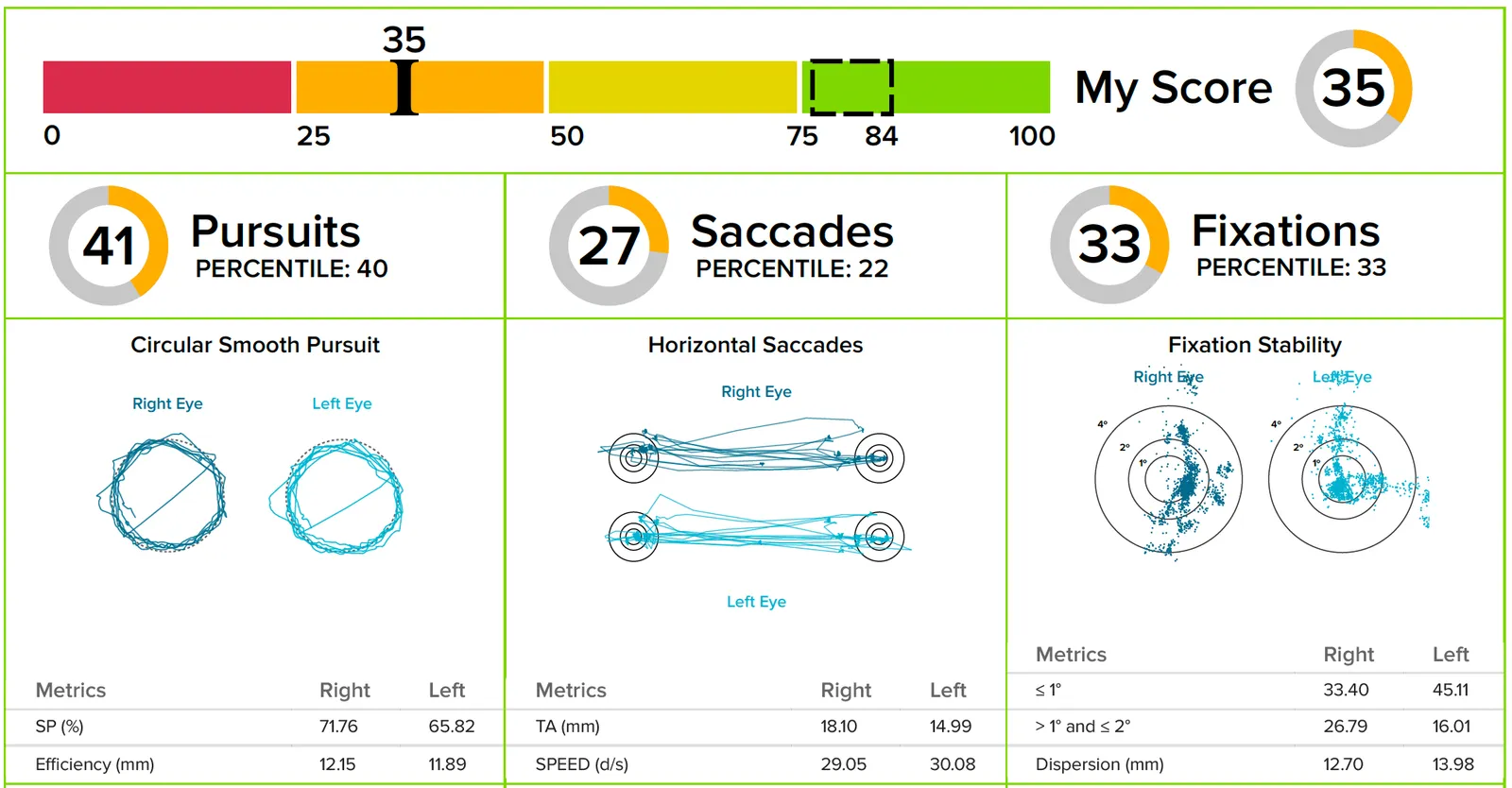 RightEye report showing moderate ocular motor dysfunction: an overall score of 35 out of 100, with roughly circular but uneven pursuit tracings and saccades that overshoot the targets.