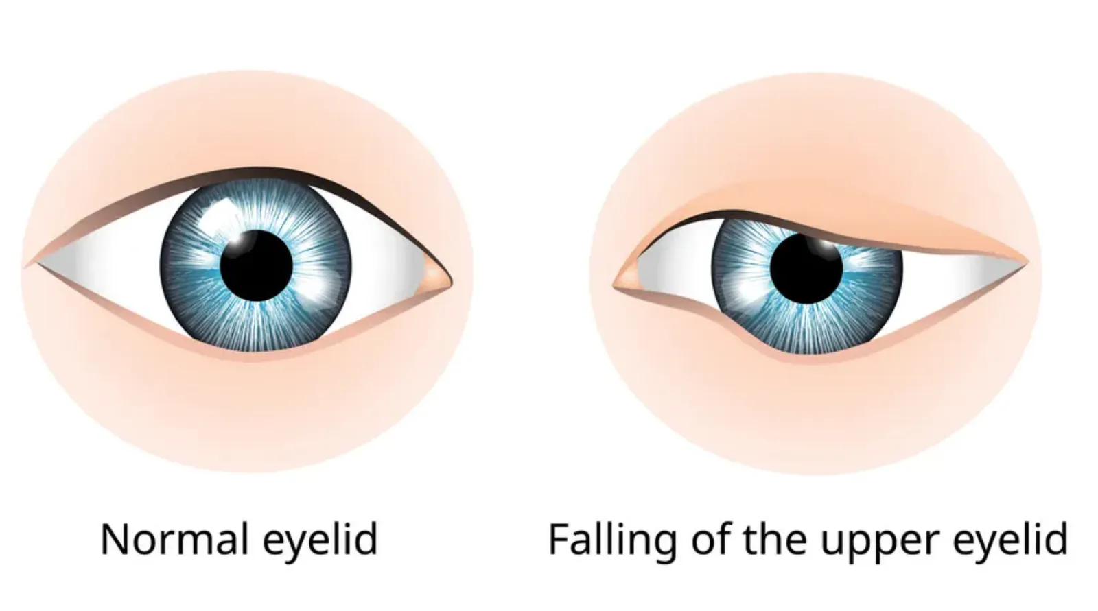 Side-by-side illustration comparing a normal eyelid with ptosis, where the upper eyelid falls low over the eye.