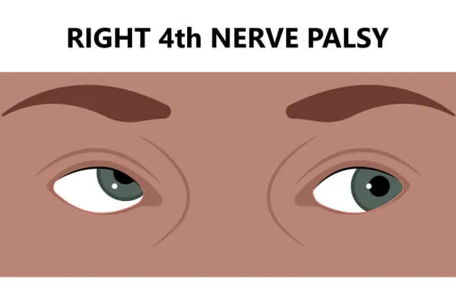 Illustration of a right fourth nerve palsy: the right eye sits higher than the left when looking straight ahead.
