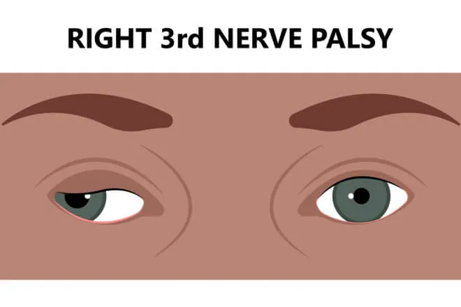 Illustration of a right third nerve palsy: the right upper eyelid droops over a pupil that sits low and turned outward.