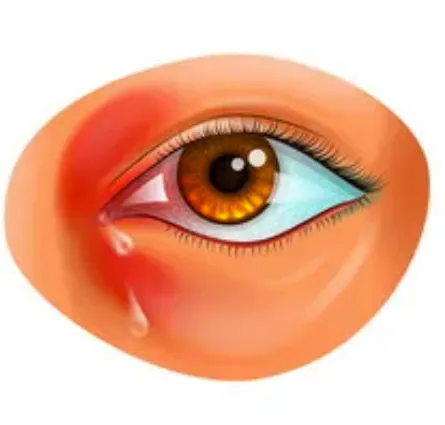 Illustration of an eye with dacryocystitis: redness and swelling beside the nose over the tear sac, with a tear running down the cheek.