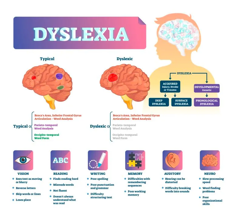 Dyslexia infographic comparing word-analysis pathways in typical and dyslexic readers, with common vision, reading, writing, memory, auditory and processing signs