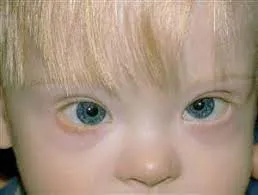 Close-up of a young child's face showing redness and irritation along the lower eyelid margins