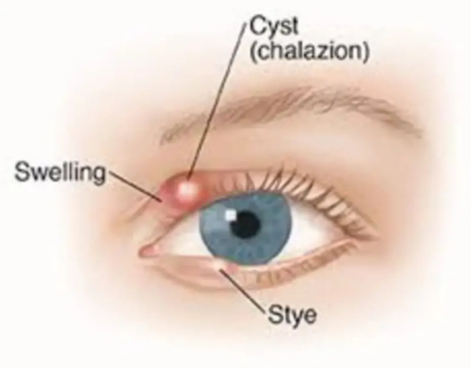 Illustration of an eyelid with a chalazion: a cyst and swelling in the upper lid, with a stye labeled on the lower lid.
