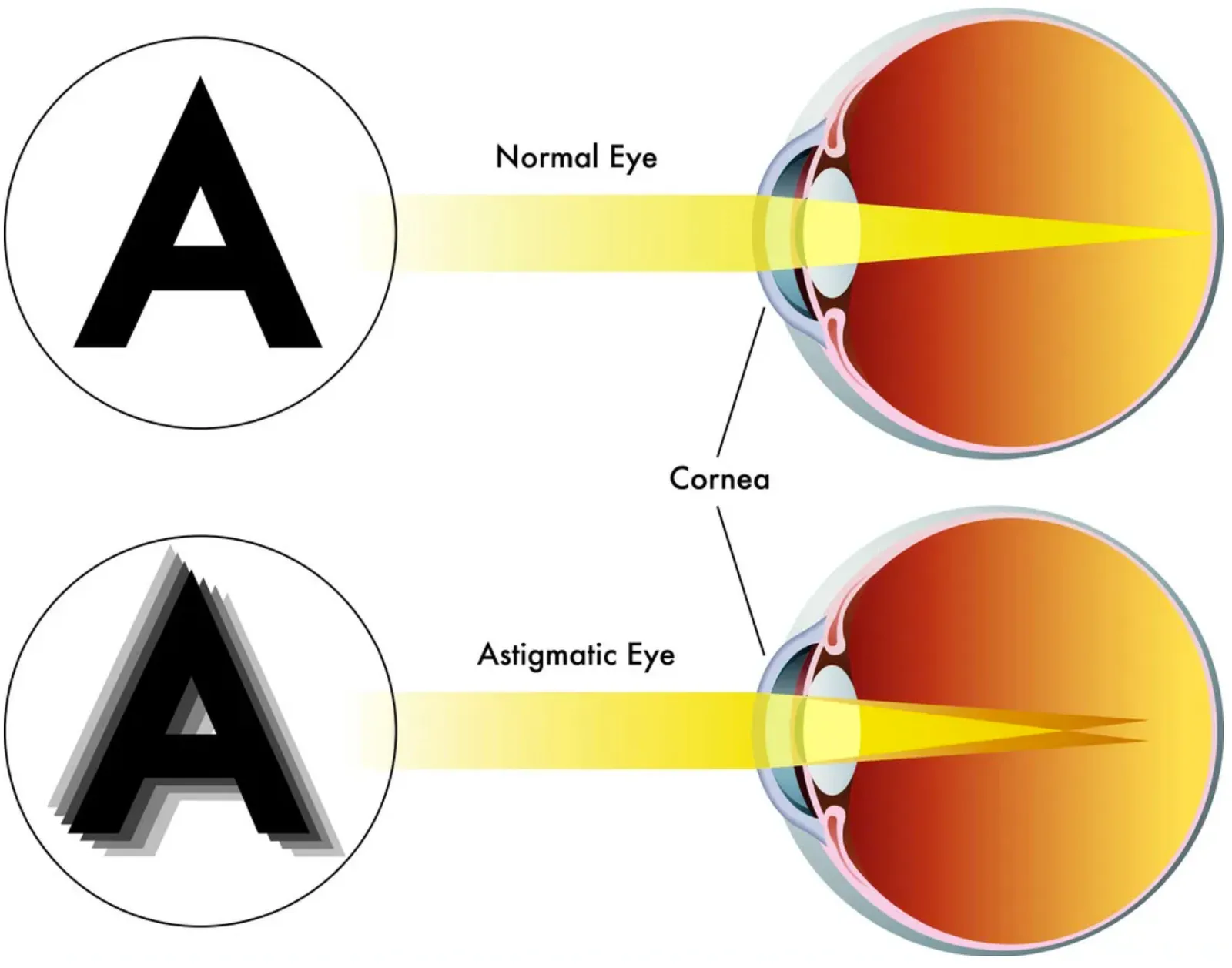 A normal eye focusing light from the letter A to a single point, above an astigmatic eye focusing the same light to two points, with the letter A shown ghosted and blurred