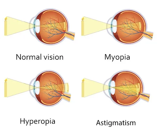 Four cross-sections of the eye comparing where light comes to a focus in normal vision, myopia, hyperopia and astigmatism