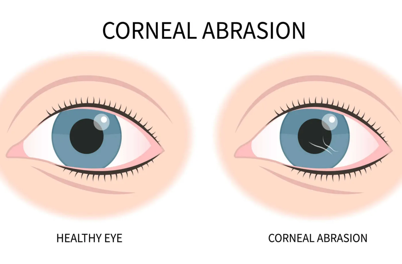 Labeled two-panel illustration titled Corneal Abrasion, comparing a healthy eye with an eye whose cornea shows fine surface scratches