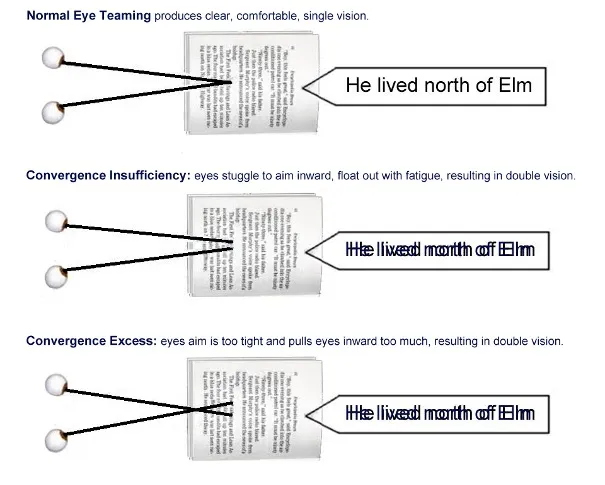 Diagram comparing normal eye teaming with convergence insufficiency and convergence excess, showing how print doubles when the eyes aim in front of or behind the page