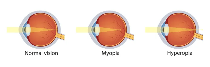 Three cross-section diagrams of the eye labeled normal vision, myopia and hyperopia, showing light focusing on the retina, in front of the retina, and behind the retina