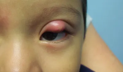A firm, painless chalazion bump on a young child's upper eyelid