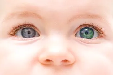 Close-up of a baby's face showing one blue-grey iris and one green iris, an example of heterochromia