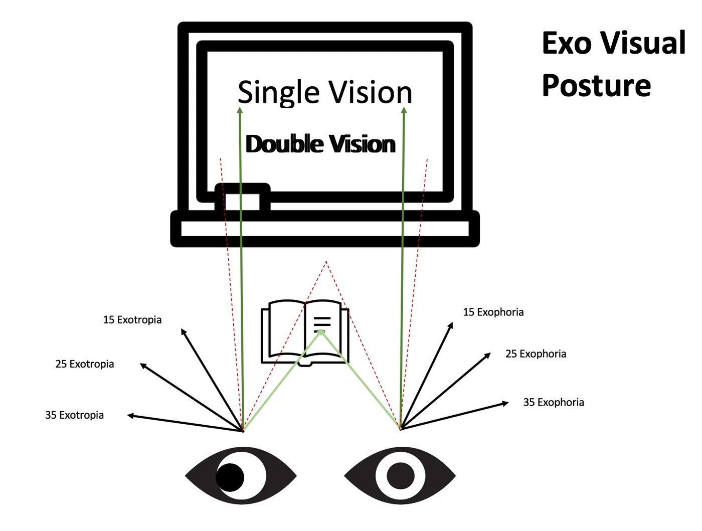 Diagram of an exo visual posture: green lines from both eyes converge comfortably on a distant monitor whose screen is labeled both "single vision" and, in a doubled ghosted font, "double vision," while red dashed lines fail to meet on a nearby book; side arrows show increasing exophoria and exotropia.