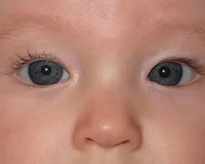 Baby whose left eye turns inward, a sign of strabismus