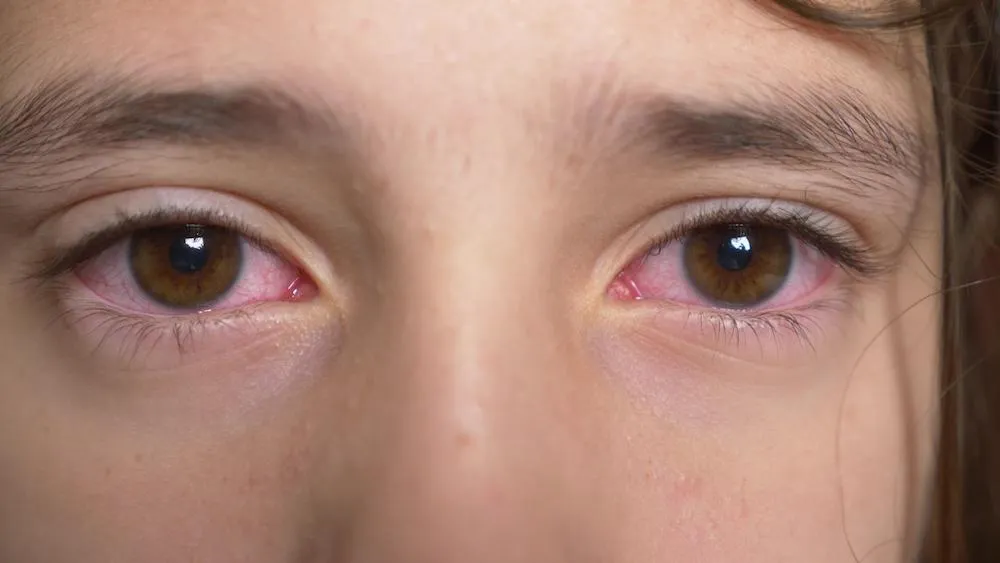 Close-up of a preschooler's eye with the redness, lid swelling and thick discharge typical of bacterial conjunctivitis